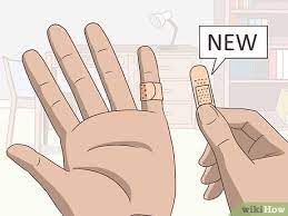 How To Treat A Blistering Burn On Your Finger: 14 Steps