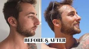 Maybe you would like to learn more about one of these? Male Before After Rhinoplasty Nose Job 12 Weeks Post Operation 12 Weeks After Youtube