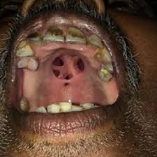 Image result for Tertiary Syphilis