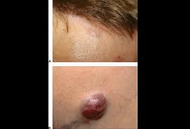 A red or pink spot looking much like an insect bite, testing revealed that the reddish spot on this patient's shin was actually merkel cell carcinoma. Merkel Cell Carcinoma Picture Image On Medicinenet Com