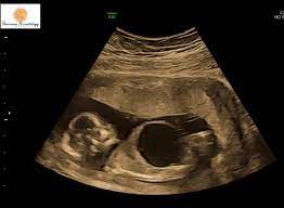 A Mom Shares Her Story Of Her Twin Boys Time In Nicu Babyyumyum