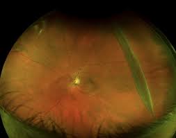 This is likely due to the vessels blocking the exiting light. Giant Retinal Tear Left Eye Retina Image Bank