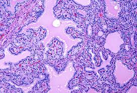 Grave's disease graves' disease is a type of hyperthyroidism that is due to the production of autoantibodies against the tsh receptor on the follicular epithelial cells. Frontiers The Pathology Of Hyperthyroidism Endocrinology