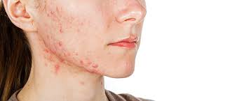 Hudlegene hos aleris tar problemet ditt på alvor. Slik Blir Du Kvitt Akne Hudlege Dermatolog Aleris