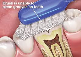Tooth sealants protect newly erupted permanent molars against cavities. Dental Sealants The Children S Choice Pediatric Dentistry Spokane Washington