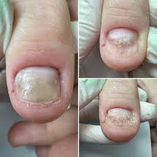 Image result for Onychotillomania feet