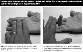 Staged digital flexor tendon reconstruction sebastian c. Pediatric Hand Injuries Part Ii Lacerations Amputations Bites And Nail Bed Injuries 2009 10 01 Ahc Media Continuing Medical Education Publishing