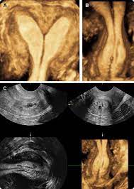Evaluation of endocrine abnormalities, including polycystic ovaries 4. Consider Ultrasound First For Imaging The Female Pelvis American Journal Of Obstetrics Gynecology