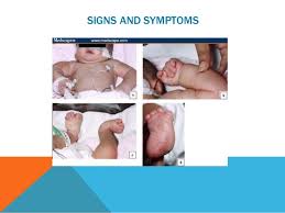 Parental origin of the extra chromosome 18 in edwards syndrome. Edward S Syndrome Trisomy 18