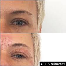 Did You Know Our Sister Academy Tebori Academy Offers Lyft Plasma Pen Training Also Skin Tightening Treatments Combination Skin Face Wash Skin Treatments