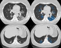 The person lies on a table that moves through a scanning ring, which looks like a large doughnut. Ct Scan Database Of 1000 Sets Was Created For Teaching Ai To Diagnose Covid 19 Eurekalert Science News