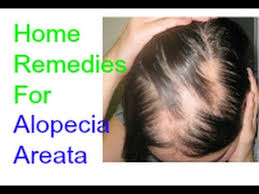 Alopecia Areata Natural Home Remedies Treatment Youtube