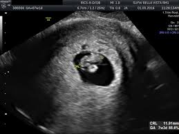 The scan is optional and not everyone will have it. Breathe Gently Dating Scan