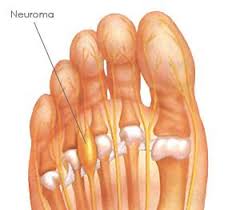 Le Nevrome De Morton Cree Des Engourdissements Brulures Ou Chocs Electrique Dans Les Orteils Foot Remedies Morton S Neuroma Neuroma