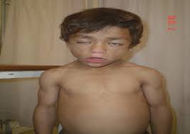 Seip (1959) reported affected brother and sister, and suggested diencephalic origin. Clinical Endocrinology And Metabolism