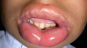 Food Allergy Rash Other Symptoms Management And Treatments