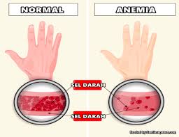 Tekanan darah rendah dapat disebabkan oleh beberapa kondisi, seperti dehidrasi, alergi, dan. 3 Punca Utama Penyakit Kurang Darah Merah Anemia Sentiasa Panas