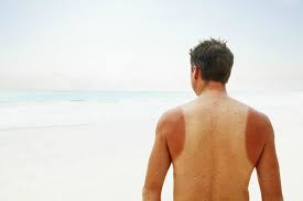 Saedi is a big fan of burt's bees sunburn solution. How To Treat Sunburn Best Ways To Get Rid Of Sunburn Fast The Manual