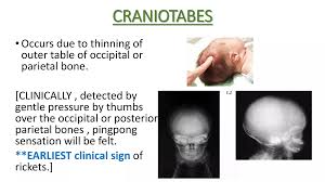 Image result for Craniotabes