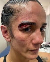 Amanda Serrano shows off gruesome cut suffered from numerous head butts in  Katie Taylor rematch