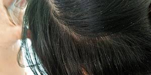 Garam bukan hanya digunakan sebagai. Cara Menghilangkan Telur Kutu Rambut Secara Alami Enak