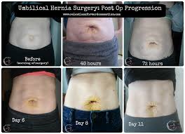 Those types of meals trigger the gallbladder to contract. What To Expect During Umbilical Hernia Surgery Recovery Relentless Forward Commotion