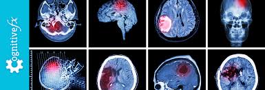 Image result for Postconcussion Syndrome