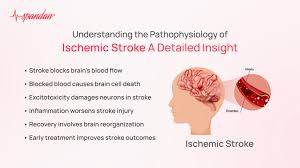 Image result for Stroke Pathophysiology