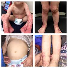 Image result for dermatitis contacta children