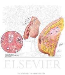 Image result for Mastalgia