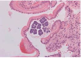 2 this happens when the cells divide in a perpendicular 4 examples: Sarcina Ventriculi Bacteria In Stomach And Duodenum Of A Patient With Gastrooesophageal Obstruction By Adenocarcinoma Insight Medical Publishing