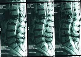 Image result for Vertebral Compression Fracture