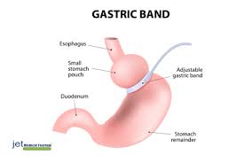 For example the cost of gastric band surgery in turkey is up to 70. What Is Lap Band Removal Surgery Lap Band Removal Cost Recovery
