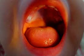 Die ansteckung mit scharlach erfolgt über tröpfcheninfektion, sehr selten auch über schmierinfektion. Scharlach Differenzierung In Der Praxis Dr Langenbeck