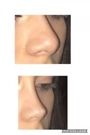 Surgery Nose Surgery Rhinoplasty Nose Jobs Nose Job Rhinoplasty