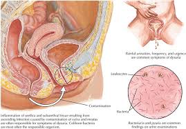 Image result for Dysuria