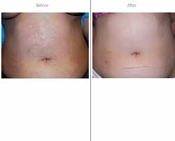 The news for anyone interested in laser hair removal in miami is that they can now visit our location at their leisure. Women Tummy Laser From Laser Hair Removal Miami In Miami Beach Fl 33154