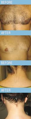Gentle, fast, effective hair removal for all skin types. Laser Hair Removal Evelinecharles Salons Spas Beauty Md