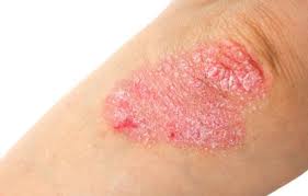 Maybe you would like to learn more about one of these? á… Manchas Rojas En La Piel Que No Pican Que Puede Ser Esdoctor