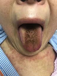Image result for black hairy tongue symptoms