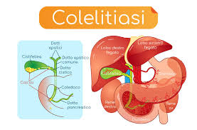 Consopevole la strada per la farmacia e la conversazione umiliante su un antidoto alla perdita di peso Calcoli Alla Cistifellea O Colecisti Sintomi Dieta Intervento