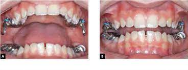 The mara appliance is ideal for noncompliant teenagers with underdeveloped lower jaws. Scielo Brasil Angle Class Ii Correction With Mara Appliance Angle Class Ii Correction With Mara Appliance
