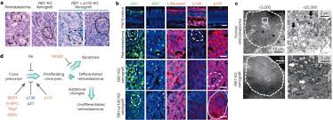 Fleurettes are eosinophilic structures composed of tumor cells with pear shaped eosinophilic processes projecting through a fenestrated membrane. Rb Suppresses Human Cone Precursor Derived Retinoblastoma Tumours Nature