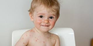 Image result for vyrážka u dětí