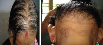 Some consider weight loss an indication for surgery. Zinc For Hair Loss Why This Mineral Matters See Photos