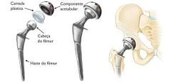 Artroplastia total de quadril (Total Hip Replacement ...