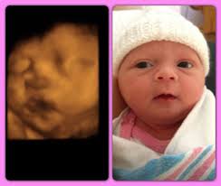 3D ultrasound images