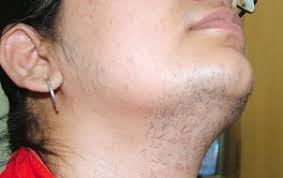 Facial hair is something that doesn't belong on women, but for many, it does. Causes Of Hair Growth In Women With Hirsutism