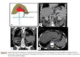 Collateral Pathways In Budd Chiari Syndrome Mdct Depiction Insight Medical Publishing