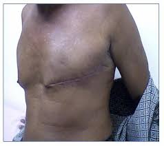 Alcohol can damage your liver, which could put your hormone levels out of whack. Male Breast Cancer Medical Pictures Info Health Definitions Photos